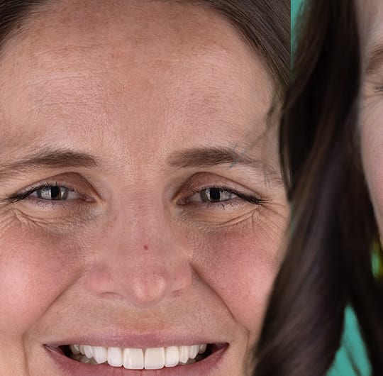 Stella from United Kingdom, after porcelain dental crown