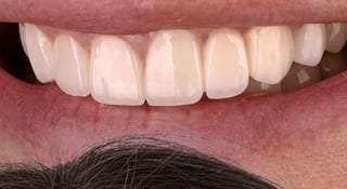 Close-up of Stella's teeth after treatment