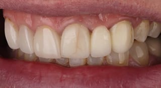 Close-up of Stella's teeth before treatment