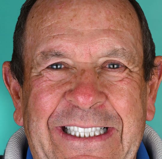 A patient smiling after porcelain crown treatment at Dental Art Alanya