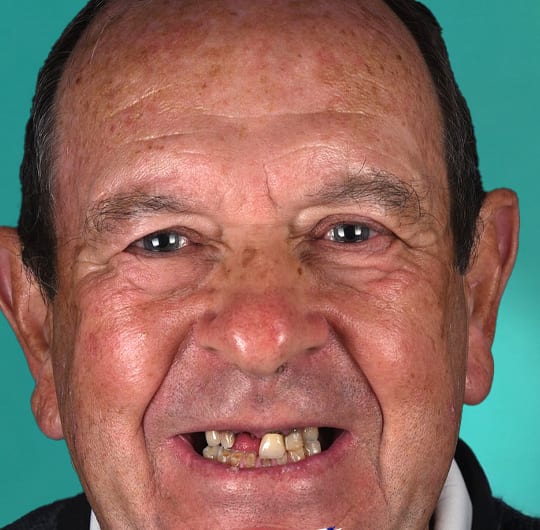 William before porcelain dental crown treatment at Dental Art Alanya