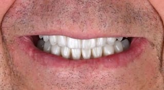 Close-up of William's teeth after treatment