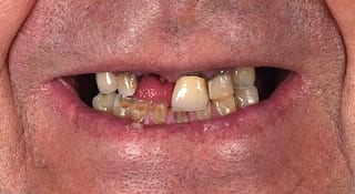 Close-up of William's teeth before treatment