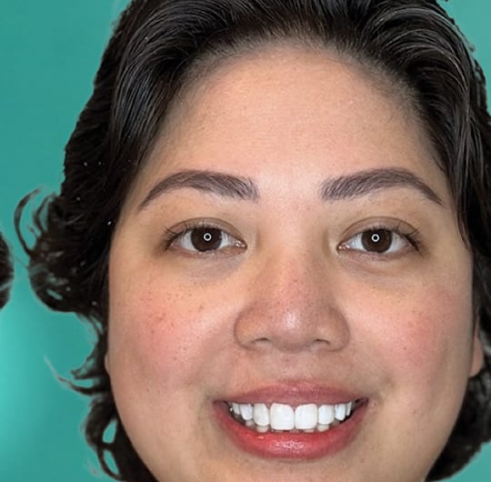 Amelia from Netherlands, after dental veneers