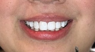 Close-up of Amelia's teeth after treatment