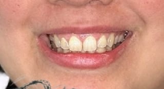 Close-up of Amelia's teeth before treatment