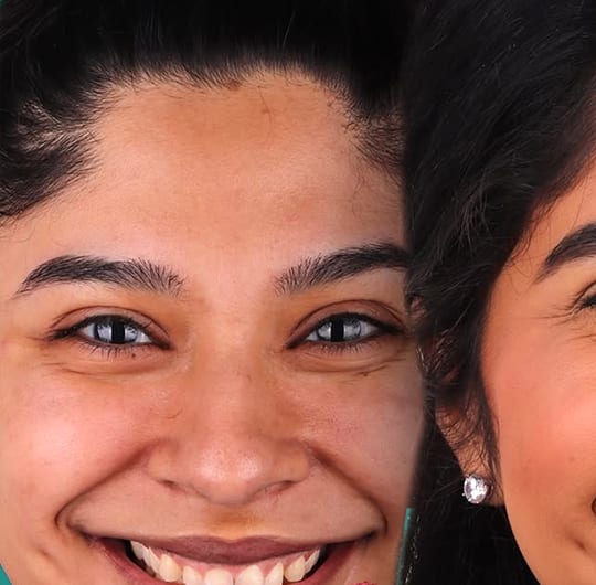 Marie before dental veneers treatment at Dental Art Alanya