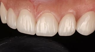 Close-up of Marie's teeth after treatment