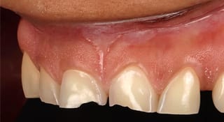Close-up of Marie's teeth before treatment