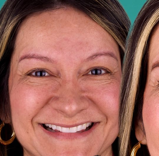 Angela before porcelain dental crown treatment at Dental Art Alanya