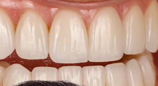 Close-up of Angela's teeth after treatment
