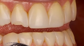 Close-up of Angela's teeth before treatment