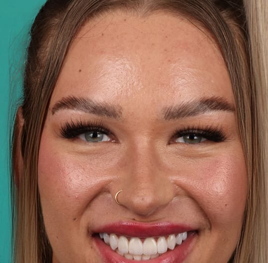 Fleur from Netherlands, after dental veneers