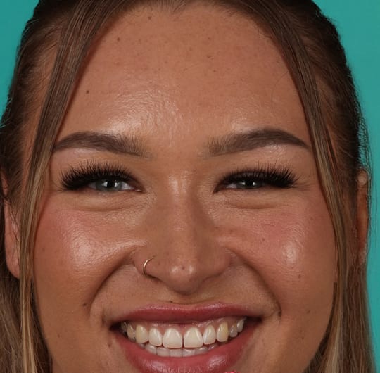 Fleur before dental veneers treatment at Dental Art Alanya