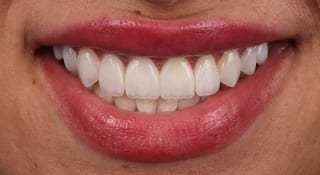 Close-up of Fleur's teeth after treatment