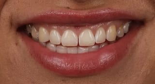 Close-up of Fleur's teeth before treatment