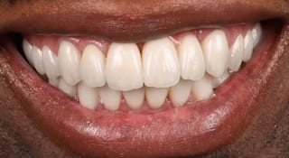 Close-up of Oliver's teeth after treatment