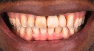 Close-up of Oliver's teeth before treatment