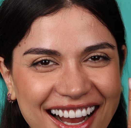 Emilia from Germany, after porcelain dental crown