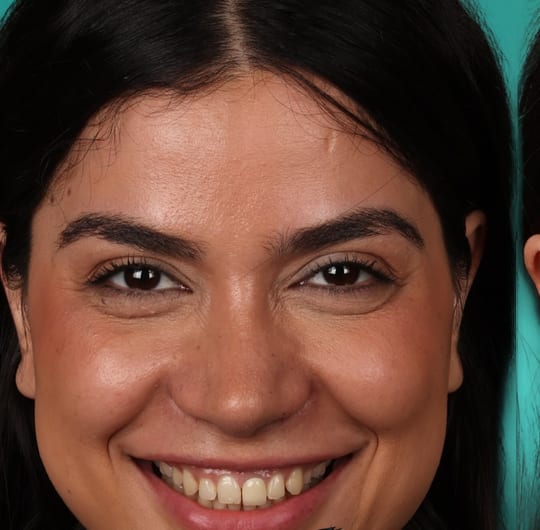 Emilia before porcelain dental crown treatment at Dental Art Alanya