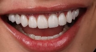 Close-up of Emilia's teeth after treatment