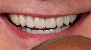 Close-up of Harry's teeth after treatment