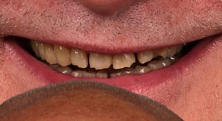 Close-up of Harry's teeth before treatment