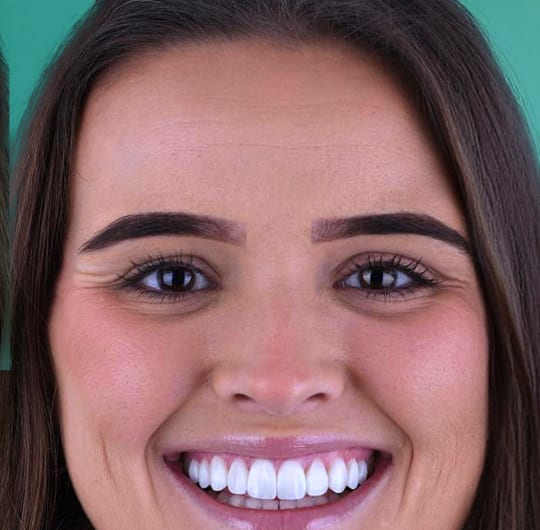 Julia from Netherlands, after dental veneers