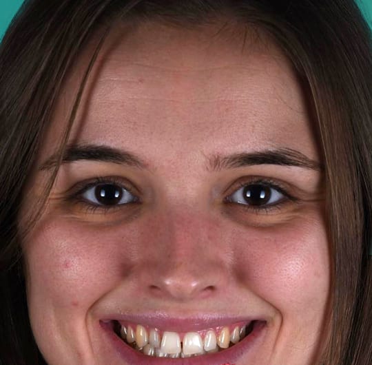 Julia before dental veneers treatment at Dental Art Alanya