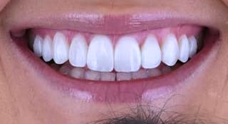 Close-up of Julia's teeth after treatment