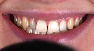 Close-up of Julia's teeth before treatment