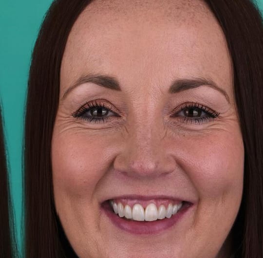 Laura from Germany, after porcelain dental crown