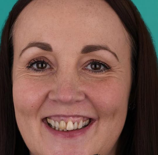 Laura before porcelain dental crown treatment at Dental Art Alanya