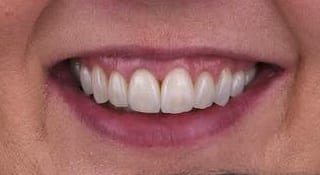 Close-up of Laura's teeth after treatment