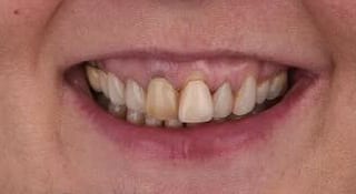 Close-up of Laura's teeth before treatment